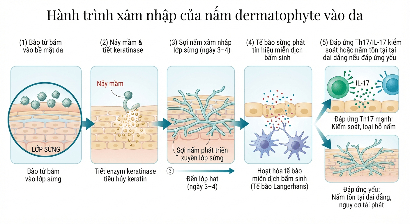 5 thể lâm sàng của nấm da bàn chân