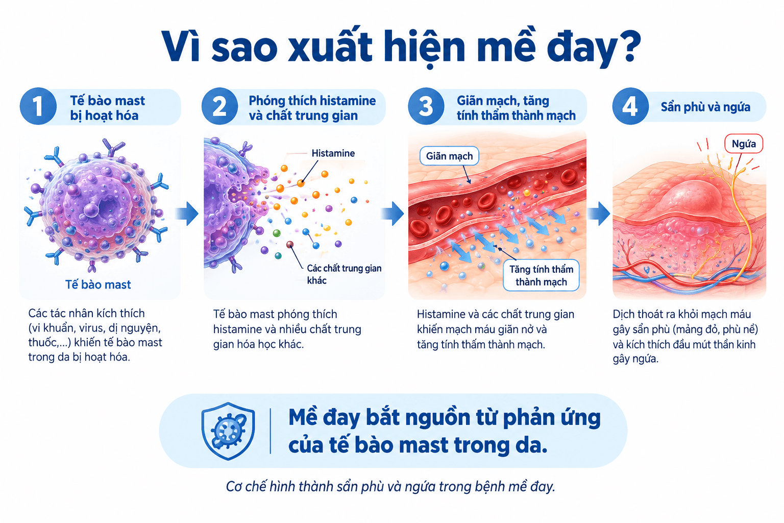 Sơ đồ cơ chế tế bào mast gây ra sẩn phù và ngứa trong bệnh mề đay.