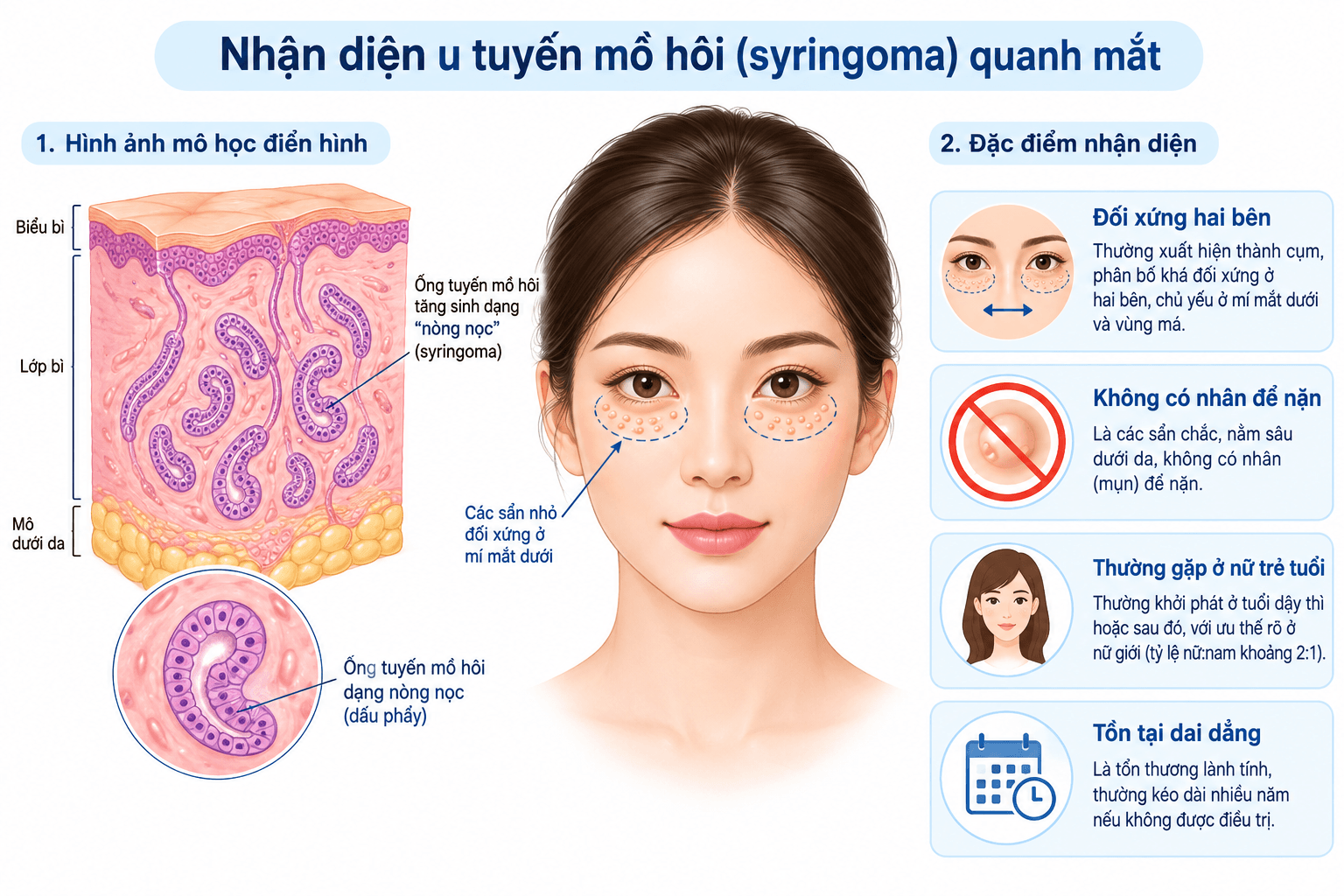 Đặc điểm điển hình của u tuyến mồ hôi (syringoma)