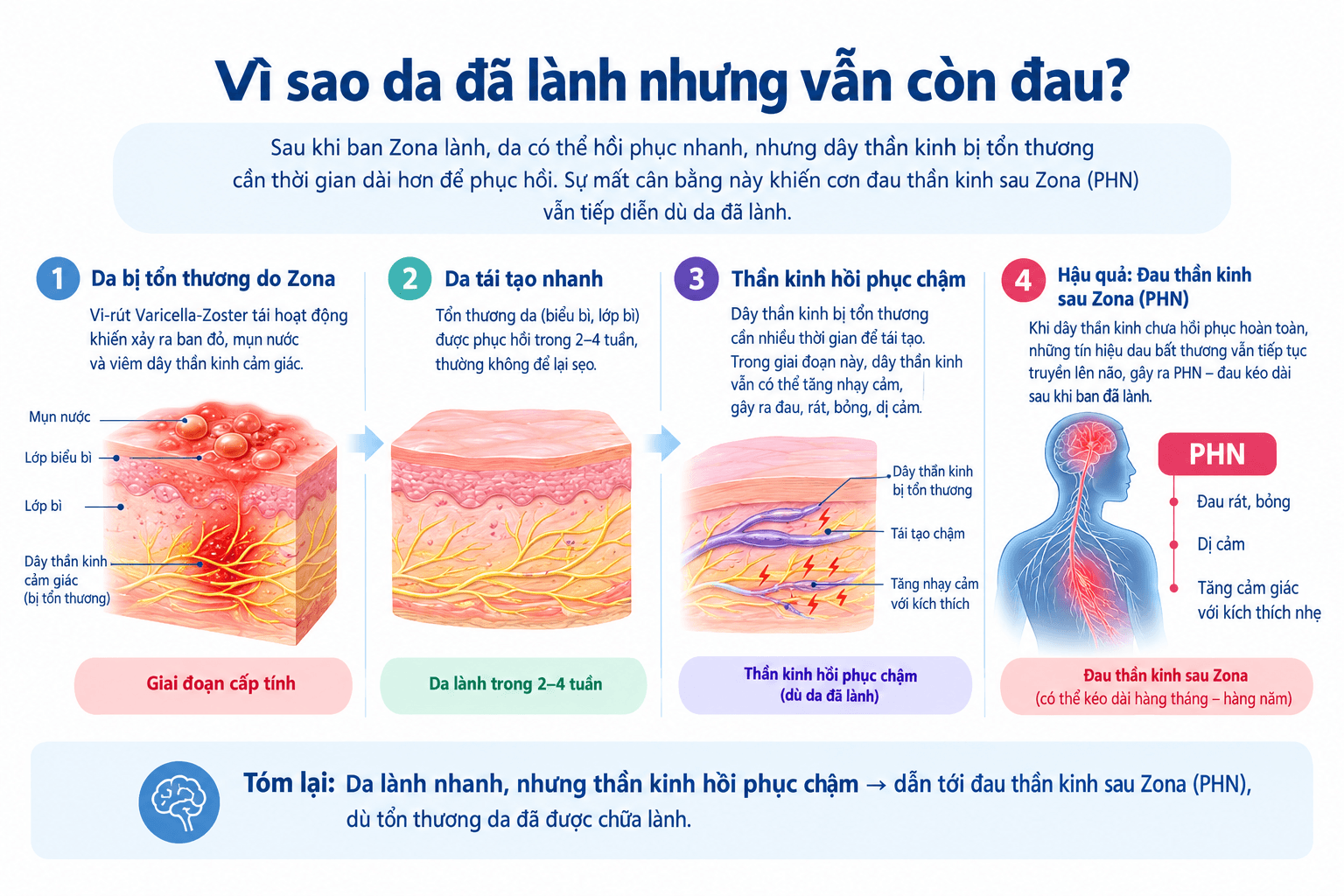 Infographic cơ chế đau thần kinh sau Zona PHN dù da đã lành.